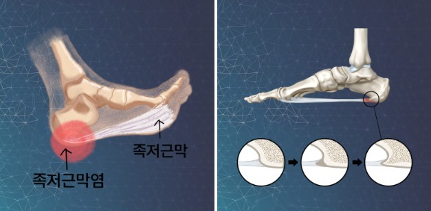 족저근막염 설명
