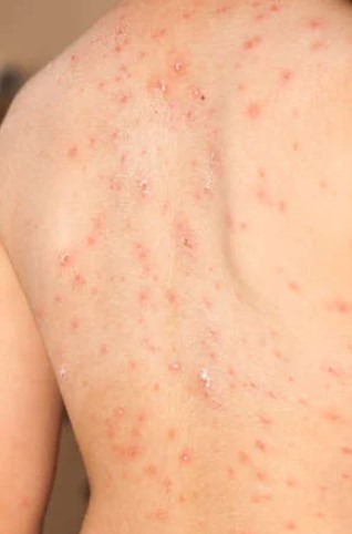 대상포진 초기증상 대상포진 조기치료 대상포진 초기증상 및 조기치료