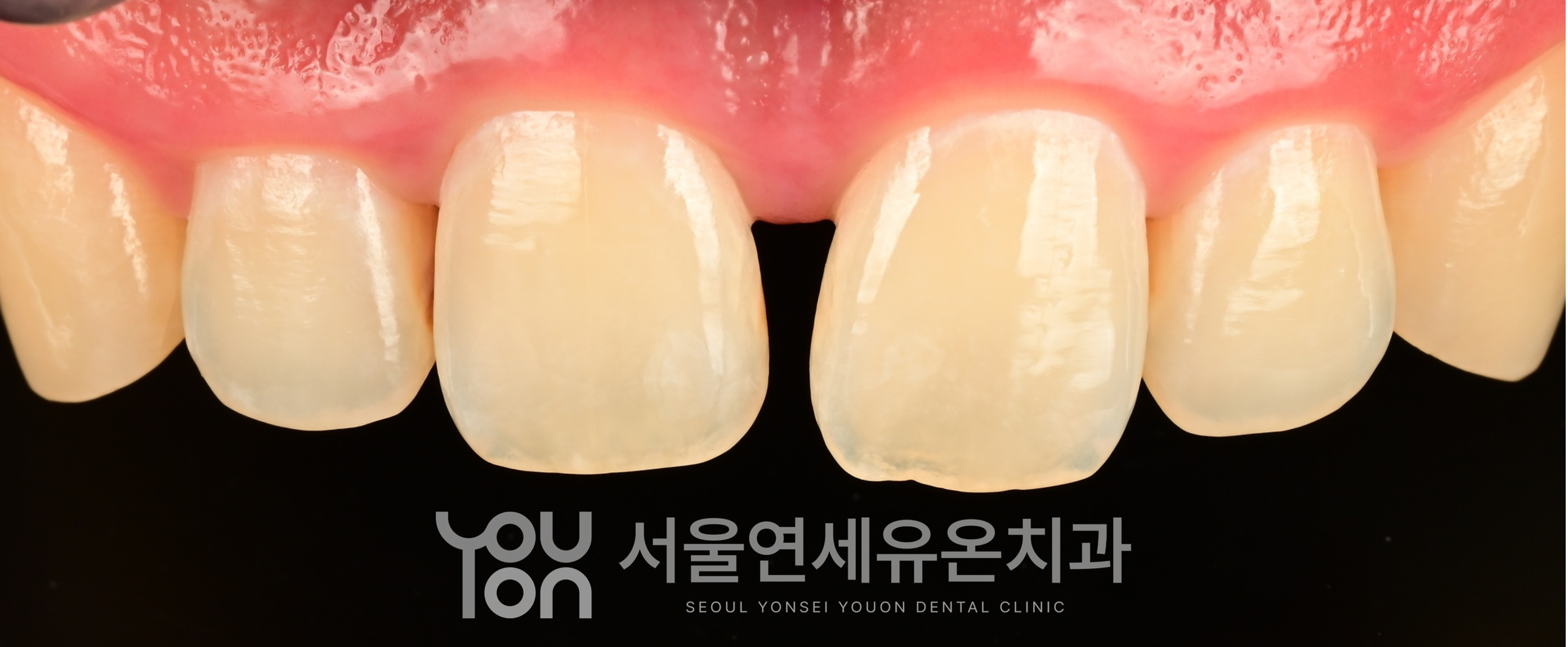 앞니 벌어짐 치료 전 잇몸 염증이 가라앉은 치아 이미지