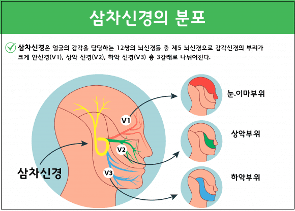 와인 마시면 오히려 도지는 질환 ㅣ 삼차신경통(Trigeminal neuralgia )이란?