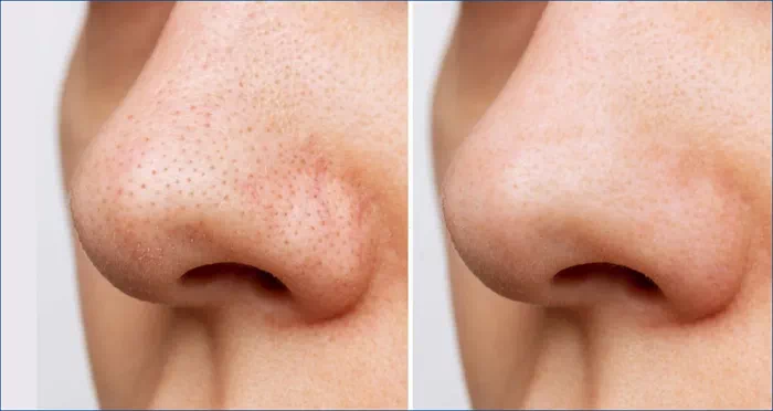모공축소 전후