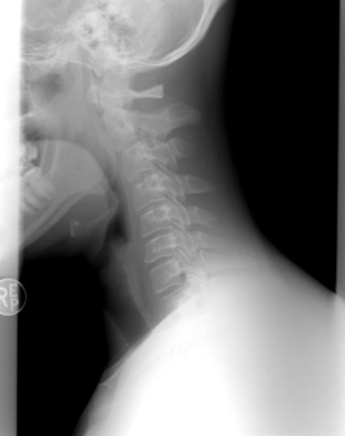 거북목이 불러오는 두통과 어깨 통증의 관계