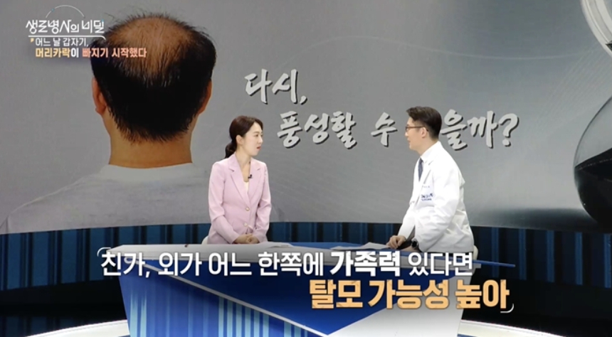 원형탈모이미지