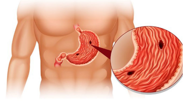 십이지장 궤양의 치료 방법
