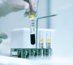 담석증 치료방법 진단기준 합병증