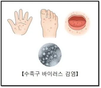 수족구병 증상과 예방 조치 방법 모음_30