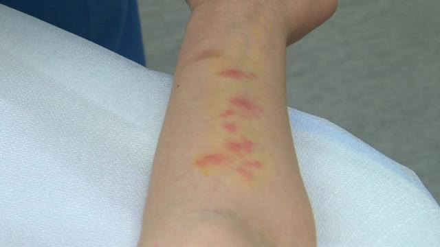 대상포진 초기증상