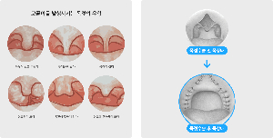 코골이