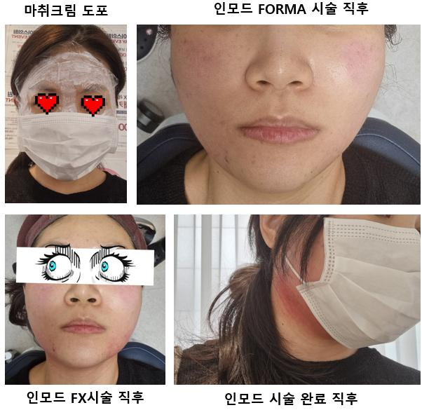 울쎄라 인모드 써마지 슈링크 차이 ❘ 리프팅 시술 어떤 피부에 맞을까?