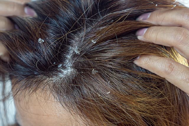 지긋지긋한 비듬이 생기는 이유와 집에서 비듬 없애는 방법