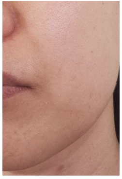 인모드fx 시술 3주후