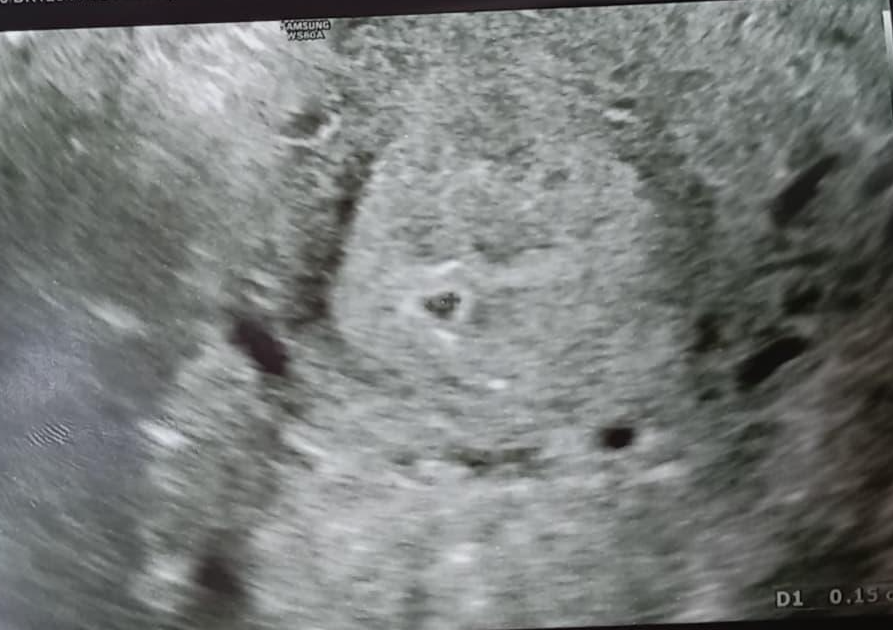 입덧🤢시작&끝나는 시기가 오기는 하는건가.. 입덧 증상과 효과봤던 가라앉히는 음식- 셋째 엄마가 알려드려요!