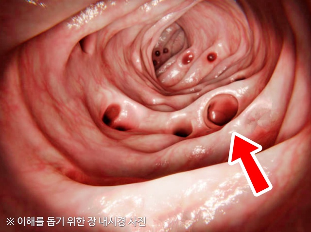 대장내시경, 장에 독소가 쌓이면, 장독소배출방법 장독소자가진단, 장게실염 대장암, 건강 팁줌 매일꿀정보