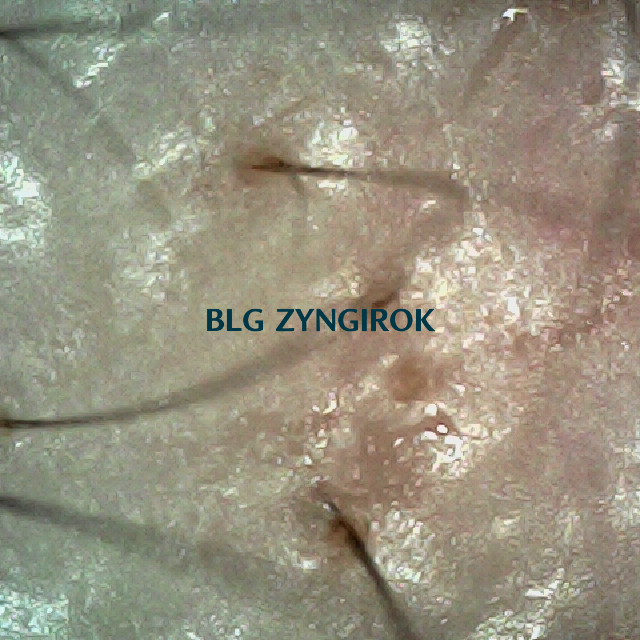 피나모아 복용 12주차 두피 사진 - 오른쪽 M자 부위 모습이다.