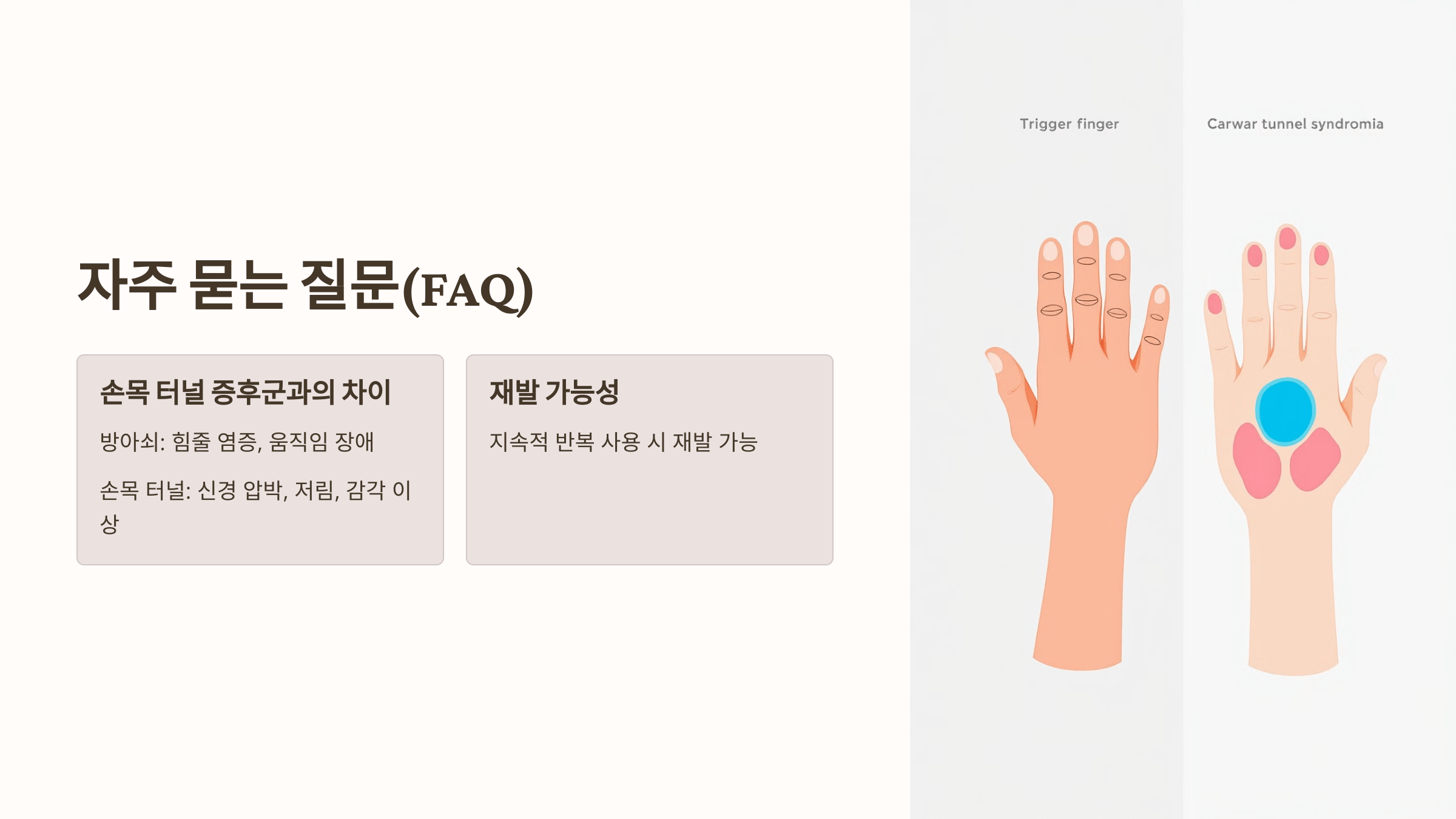 방아쇠 수지 증후군 관련된 사진입니다.