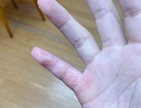 화상 후 관리법