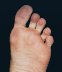 티눈 없애는 방법