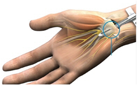 새끼 손가락 저림