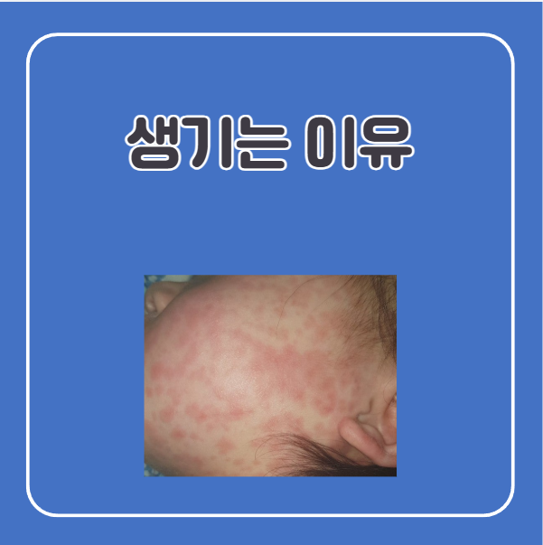 콜린성 두드러기 원인, 열꽃 두드러기 원인