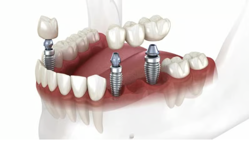 어금니 임플란트 가격