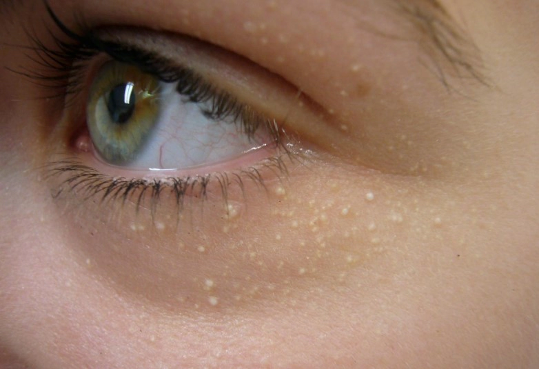 비립종 원인 생기는 이유 5가지 및 비립종 제거후 관리 Tip