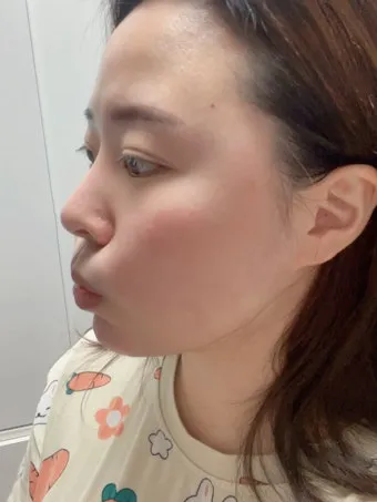 링클백 팔자주름 효과 부작용 사용후기 정보 정리_10