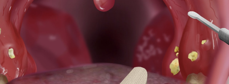 편도결석 제거기1