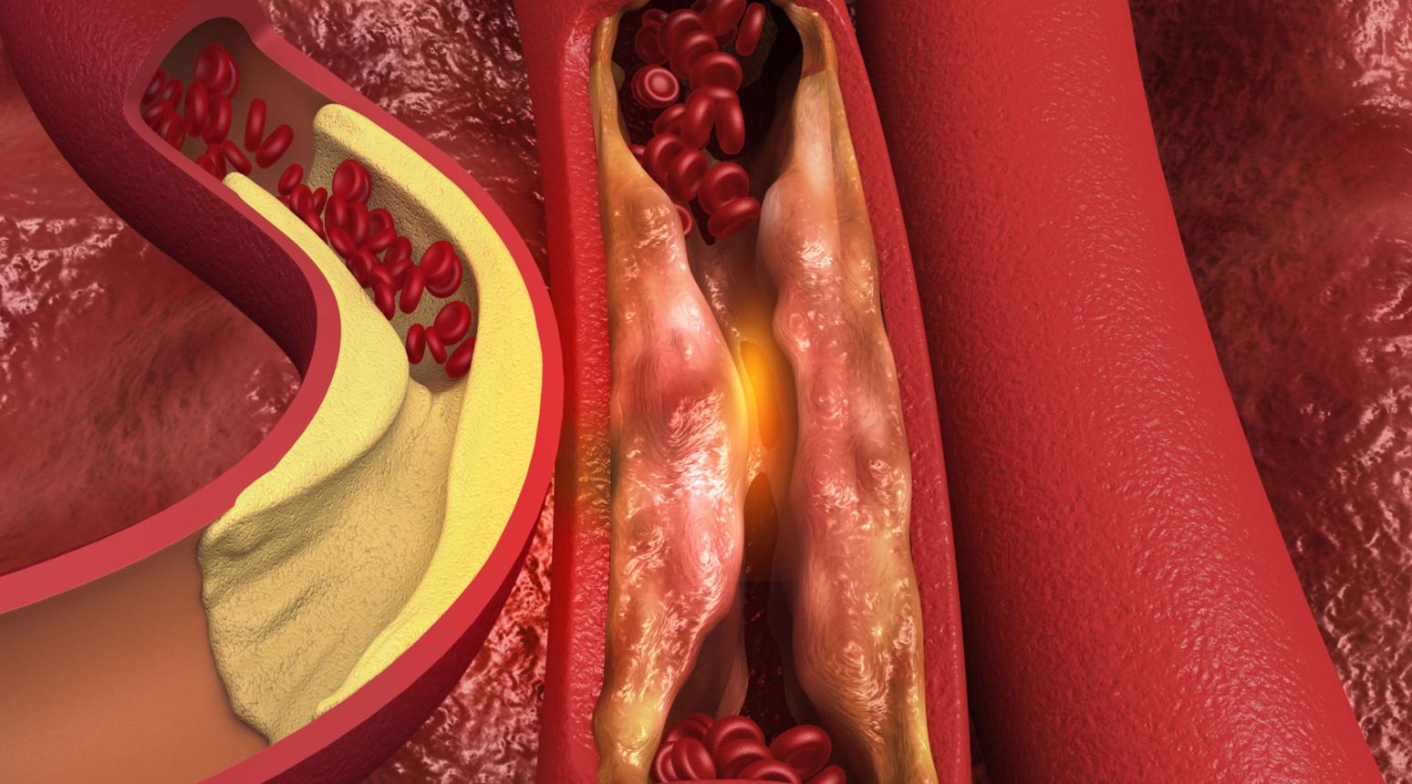 HDL가 LDL 비교 이미지