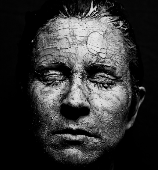 피부건조증 정확한 원인 분석 관련 사진