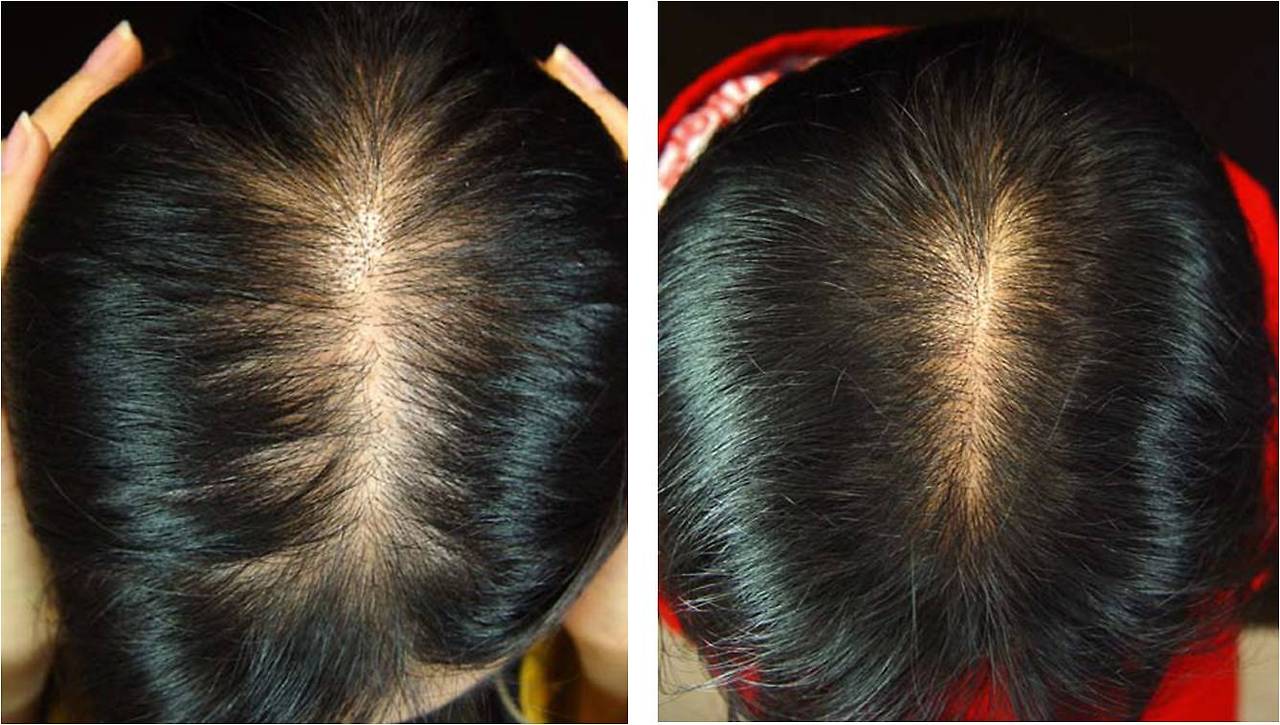 여성 탈모의 원인 및 치료법