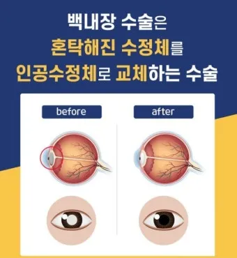 백내장 수술 비용 실비 보험 청구 회복기간_4