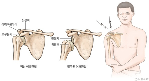 관절경수술 후 물리치료 운동 가이드