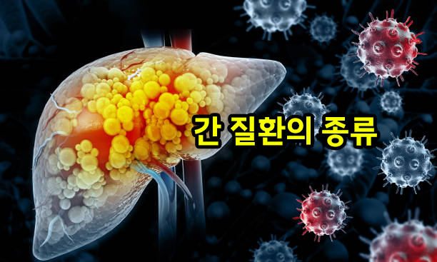 간 질환 종류