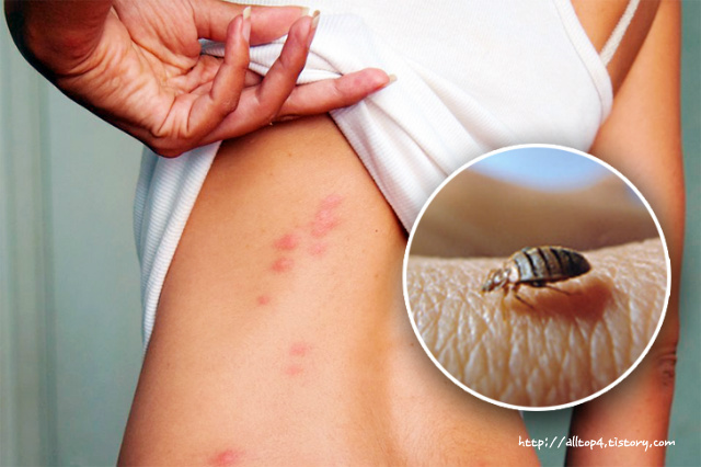 빈대물렸을때증상2