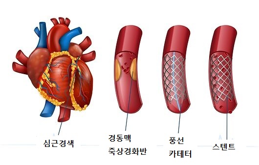 심근경색 전조증상