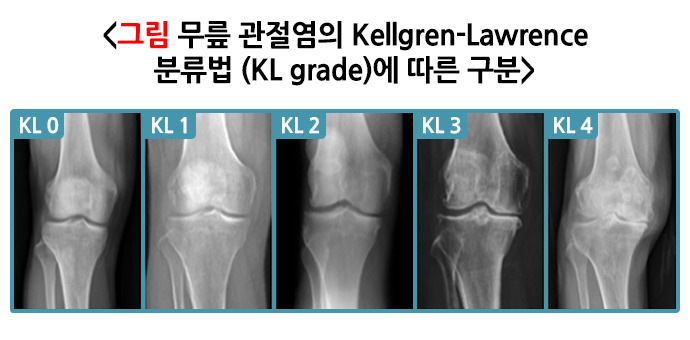 퇴행성관절염 원인, 증상, 예방, 치료방법