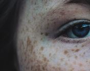 손등 검버섯 없애는 법 효과적인 방법