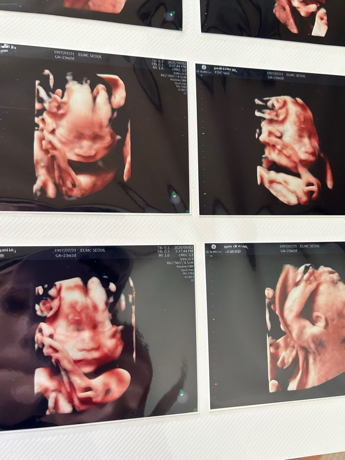쌍둥이 임신 21~24주 증상 리얼 후기