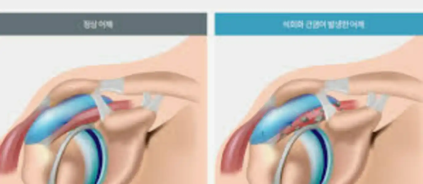 무거운 가방 한쪽으로만 메기 : 어깨 불균형의 주범!