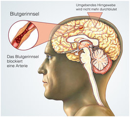 뇌경색 전조증상과 뇌졸중. 인간의 뇌는 우리 몸에서 가장 중요한 기관 중 하나입니다. 뇌를 통해 기억과 학습을 담당하고 신체 기관이 운동 기능을 수행할 수 있도록 하기 때문입니다. 뇌졸중과 뇌경색으로 심하게 손상되기 전까지는 일상생활에서 이상증상을 확인하기 어려우므로 평소에 주의를 하셔야 합니다.