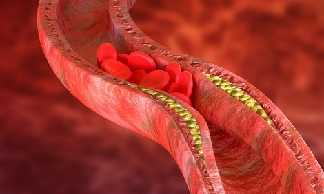 혈관-막힌-모습-그림