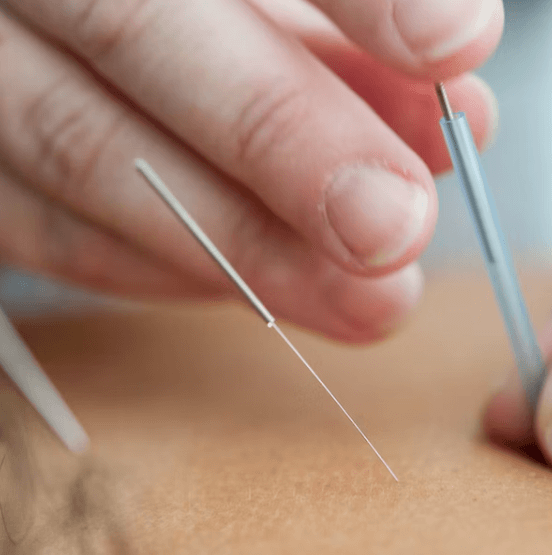 구안와사 초기증상 - 침 치료