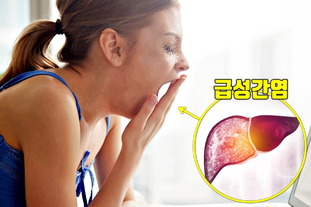급성간염 피로감, 간이 안좋을때 나타나는 증상, 간암 간경화 지방간 증상, 건강, 팁줌 매일꿀정보