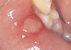 구내염 빨리 낫는 법