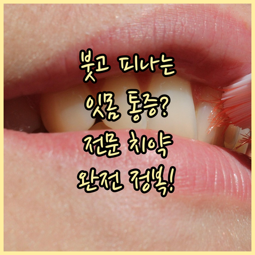 붓고 피나는 잇몸에 좋은 전문 치약 ..