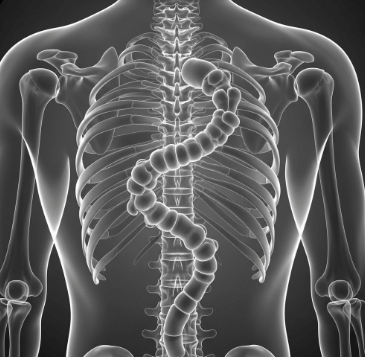 척추 측만증 증상과 원인 완벽 정리2