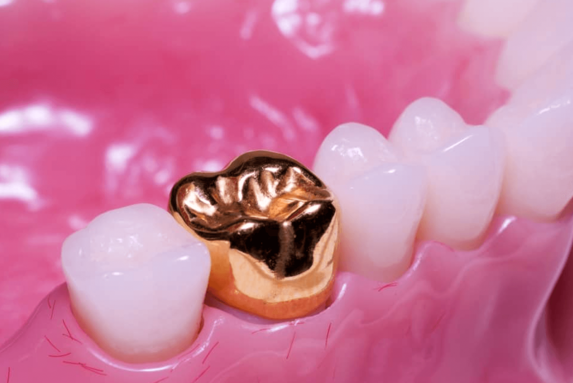 골드 크라운 가격