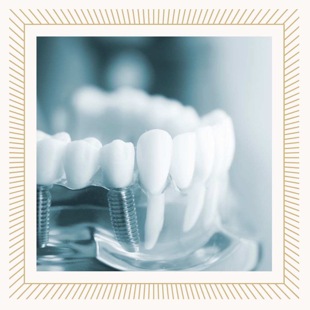 부천 임플란트 잘하는 곳