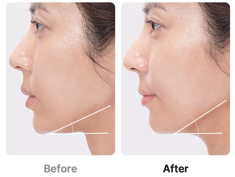 메디큐브-부스터프로-효과-사용법-4