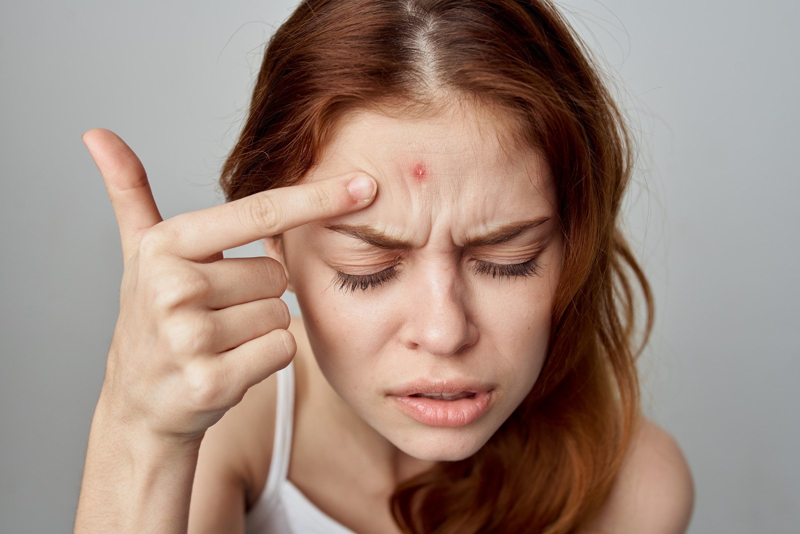 여드름(Acne): 원인, 증상, 치료 방법 완벽 가이드